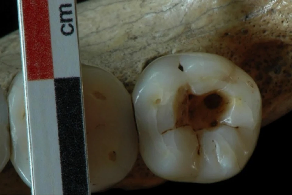Наши далекие предки знали толк в стоматологии.