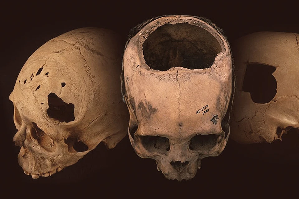 Индейцы Перу практиковали трепанацию черепа на протяжении 2000 лет.