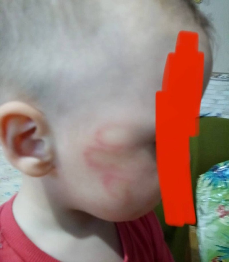 На щечке малыша остались следы от удара рукой (Фото: telegram).