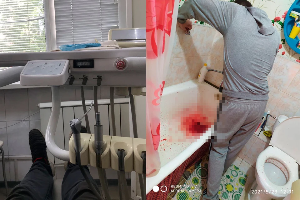 При лечении у мужчины началось кровотечение.