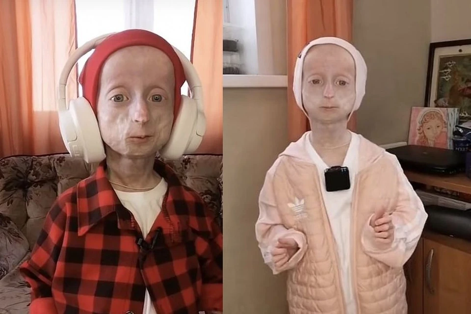 Двенадцатилетняя Аня Корчагина из Новосибирска страдает редкой болезнью — детской прогерией. Фото: ann_litle