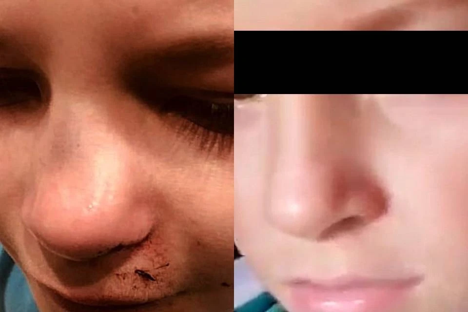 Девочка вышла из лабиринта со сломанным носом.