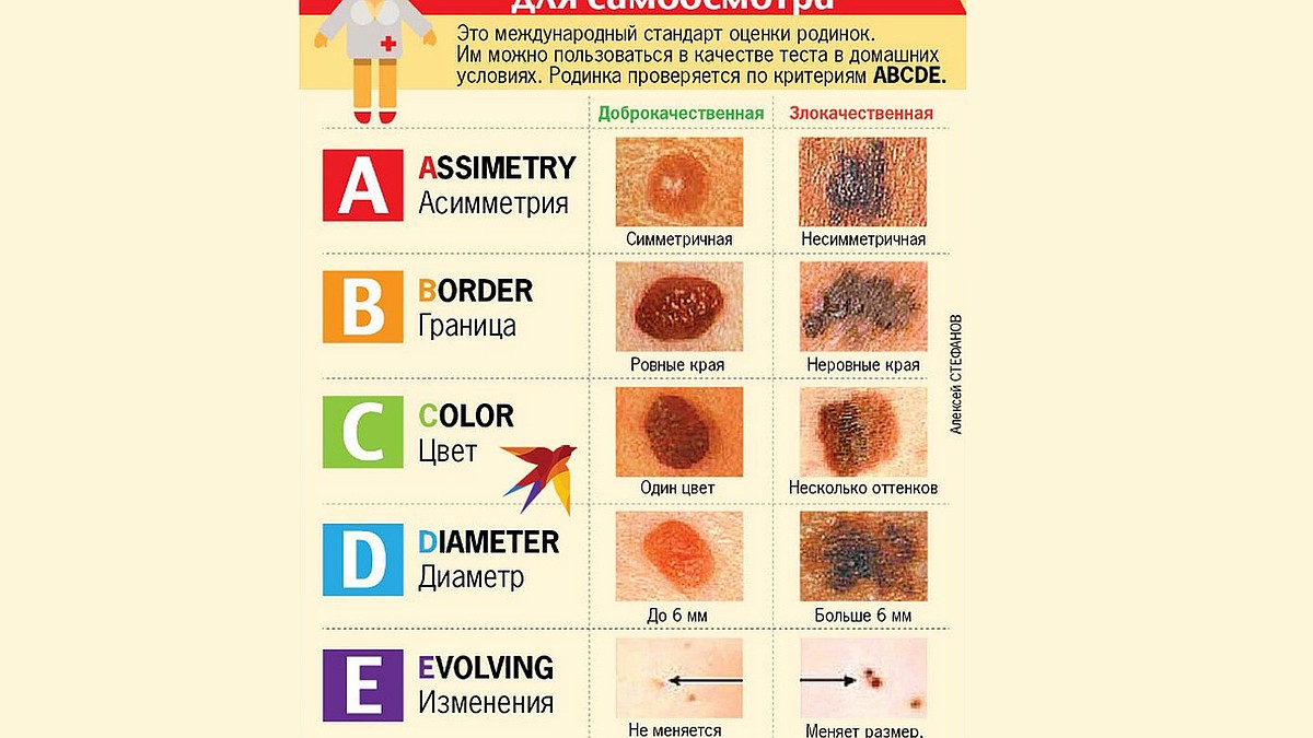 Опасная меланома - KP.RU