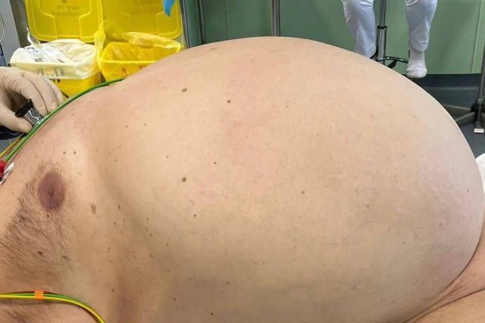 Хирурги Петербурга удалили гигантскую опухоль пациенту / Фото: Комздрав