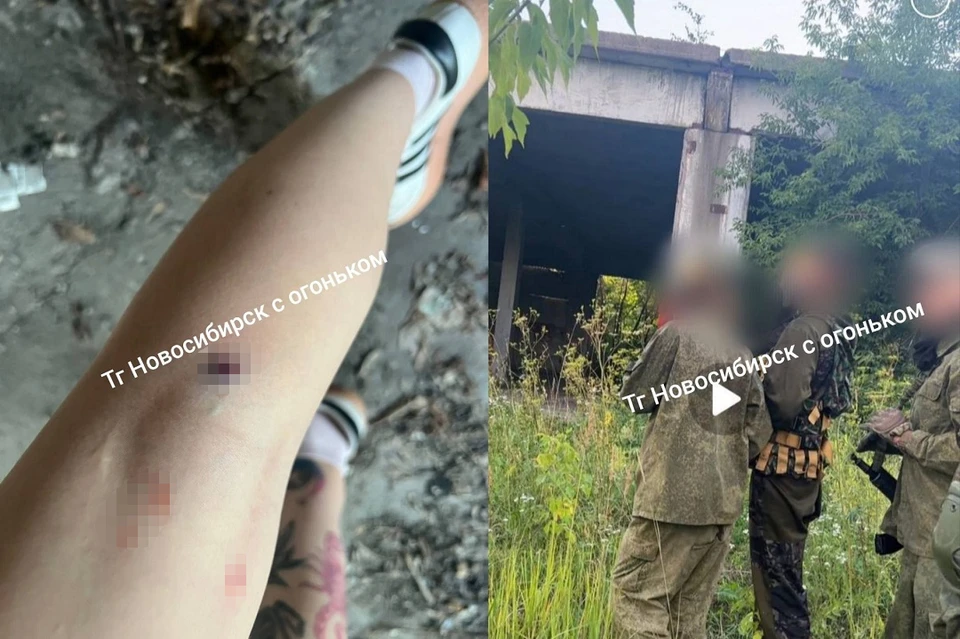 Девушки поделились снимками синяков. Фото: «Новосибирск с огоньком»