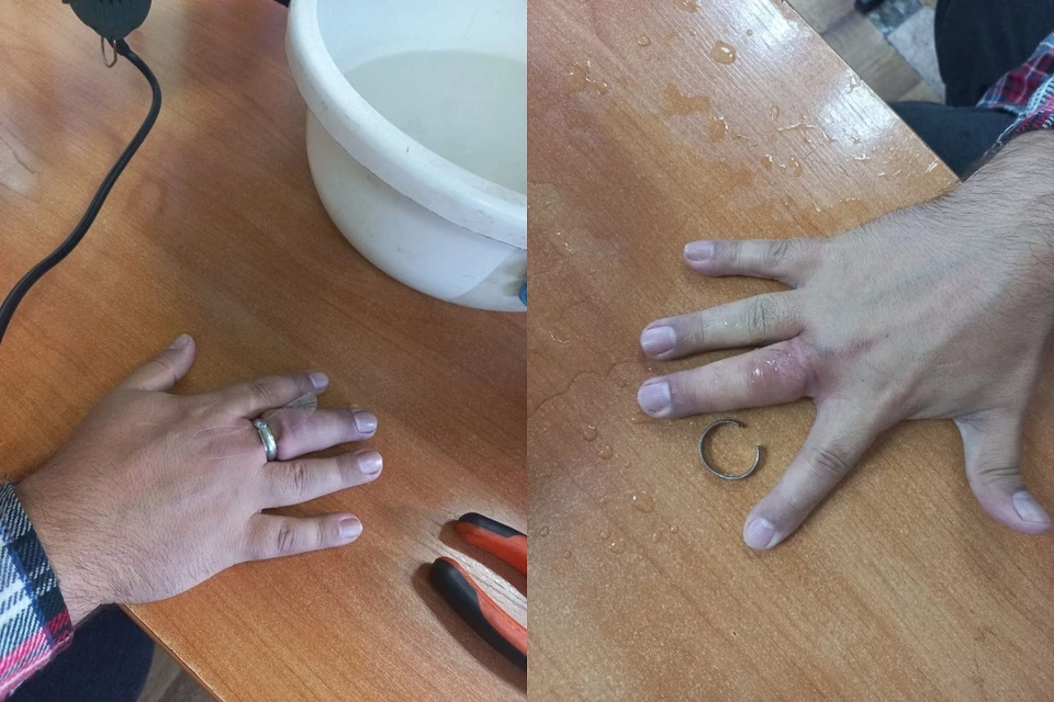 В Новосибирске спасатели спилили кольцо с опухшего пальца мужчины. Фото: МАСС.