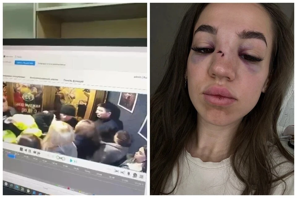 У девушки сломан нос после нападения в баре. Фото: Ирина Сердюк