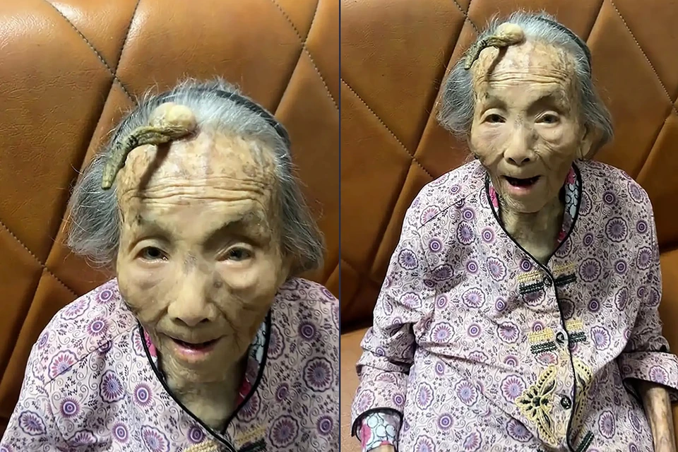 У 107-летней китаянки вырос 10-сантиметровый рог на лбу