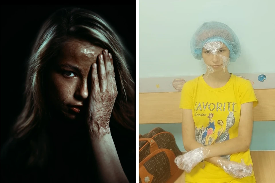 Шесть лет Лиза жила с рубцами, которые болели и расстраивали при взгляде в зеркало.