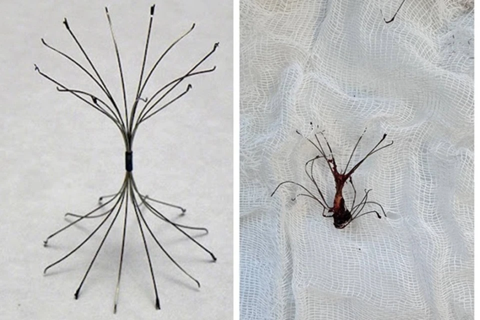 Сравнение целого и разрушенного кава-фильтра. Фото: БСМП Набережных Челнов