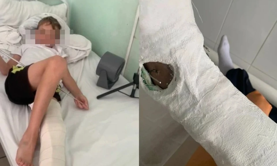 Пострадавший третьеклассник был доставлен в больницу со сложными переломами