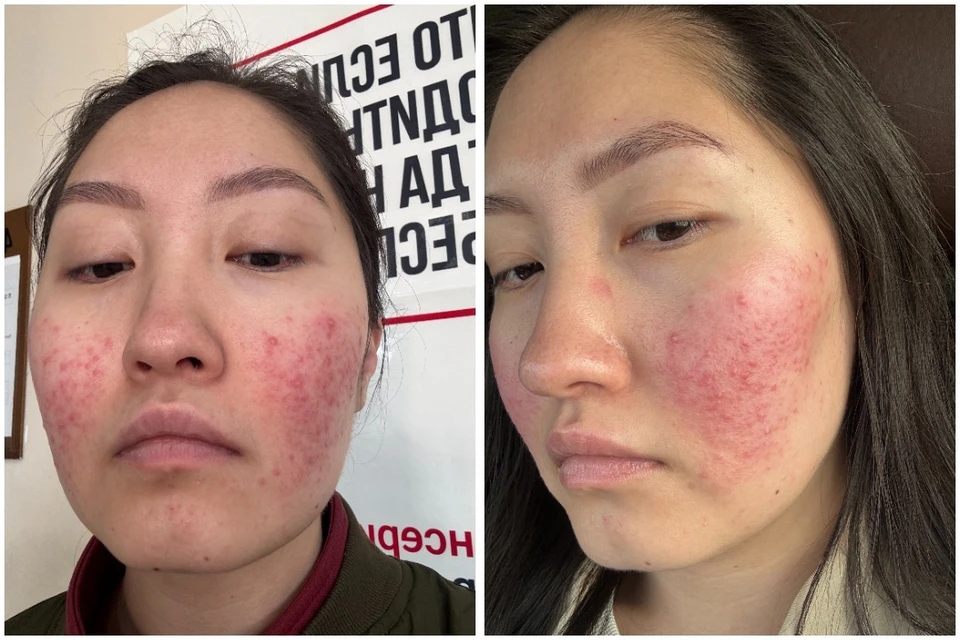 Желание получить красивые снимки «до/после» обернулось для сибирячки серьезными проблемами со здоровьем. Фото: предоставлено Александрой Гатаповой