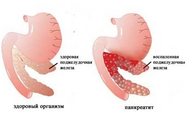 Лечение поджелудочной железы | Клиника «Медлайн» в Кемерово