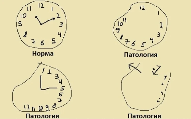 Картинки деменция тест