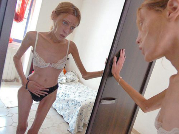 Умирающая от анорексии модель Изабель Каро в социальной рекламе "Нет анорексии"
